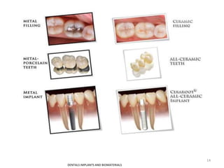 DENTALS IMPLANTS AND BIOMATERIALS
14
 