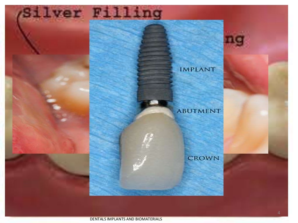 Dental implants and biomaterials