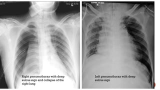chest X-ray basic knowledge and differential diagnosis | PPT