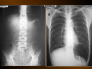 Xq bung cap dai cuong