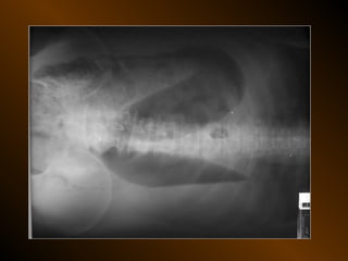 Xq bung cap dai cuong