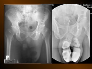 Xq bung cap dai cuong