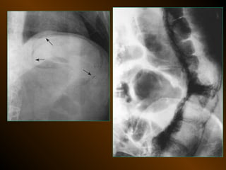 Xq bung cap dai cuong