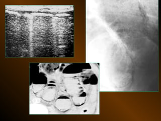 Xq bung cap dai cuong