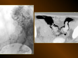 Xq bung cap dai cuong