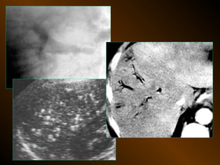 Xq bung cap dai cuong