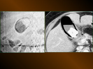 Xq bung cap dai cuong