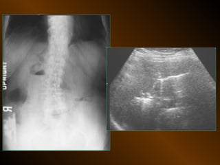 Xq bung cap dai cuong