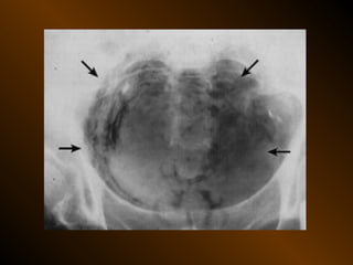 Xq bung cap dai cuong