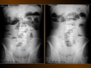 Xq bung cap dai cuong