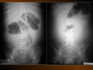 Xq bung cap dai cuong