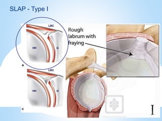 Slap Ruture Shoulder sports related injuries | PPTX