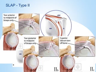 Slap Band Injuries Shoulder sports related injuries | PPTX