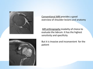 Conventional MRI provides a good
overview of shoulder lesions and anatomy
MR arthrography modality of choice to
evaluate t...