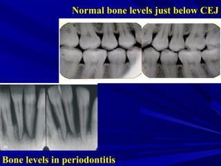 Normal Bone Level Radiograph Introduction to Dentistry 6 | PPT