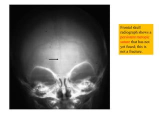 Anatomy of skull fractures | PPTX
