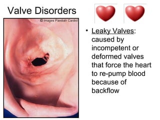 Valve Disorders
• Leaky Valves:
caused by
incompetent or
deformed valves
that force the heart
to re-pump blood
because of
backflow
 
