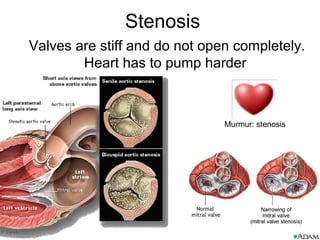 Stenosis
Valves are stiff and do not open completely.
Heart has to pump harder
Murmur: stenosis
 