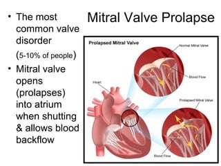 Mitral Valve Prolapse• The most
common valve
disorder
(5-10% of people)
• Mitral valve
opens
(prolapses)
into atrium
when shutting
& allows blood
backflow
 