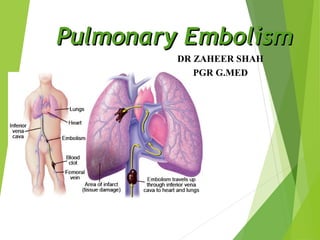 Pulmonary Embolism
DR ZAHEER SHAH
PGR G.MED

 