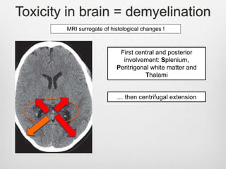 Toxicity in brain = demyelination
MRI surrogate of histological changes !
First central and posterior
involvement: Splenium,
Peritrigonal white matter and
Thalami
… then centrifugal extension
 