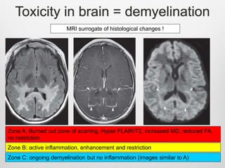Toxicity in brain = demyelination
MRI surrogate of histological changes !
Zone A: Burned out zone of scarring, Hyper FLAIR/T2, increased MD, reduced FA,
no restriction
Zone B: active inflammation, enhancement and restriction
Zone C: ongoing demyelination but no inflammation (images similar to A)
 
