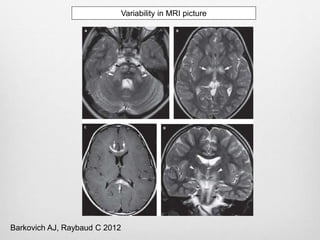 Variability in MRI picture
Barkovich AJ, Raybaud C 2012
 