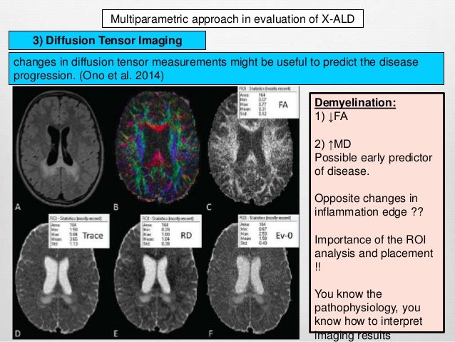 x linked adrenoleukodystrophy x linked adrenoleukodystrophy