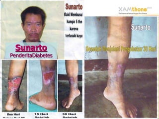 Sunarto
PenderitaDiabetes
 