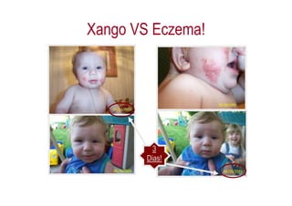 Xango VS Eczema!




          3
        Dias!
 