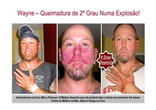Wayne – Queimadura de 2º Grau Numa Explosão!




                                                                        9 Dias
                                                                        Depois!




Queimaduras na Cara, Mão e Pescoço. O Médico disse-lhe que não poderia fazer a barba nos próximos 4-6 meses.
                             Creme do Médico na Mão. Aplicou Xango na Cara.
 