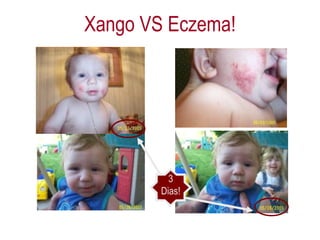 Xango VS Eczema! 3 Dias! 