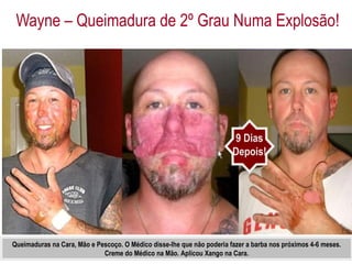 Wayne – Queimadura de 2º Grau Numa Explosão! 9 Dias Depois! Queimaduras na Cara, Mão e Pescoço. O Médico disse-lhe que não poderia fazer a barba nos próximos 4-6 meses. Creme do Médico na Mão. Aplicou Xango na Cara. 
