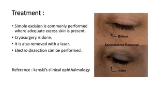 Electrodissection XANTHELASMA.pptx