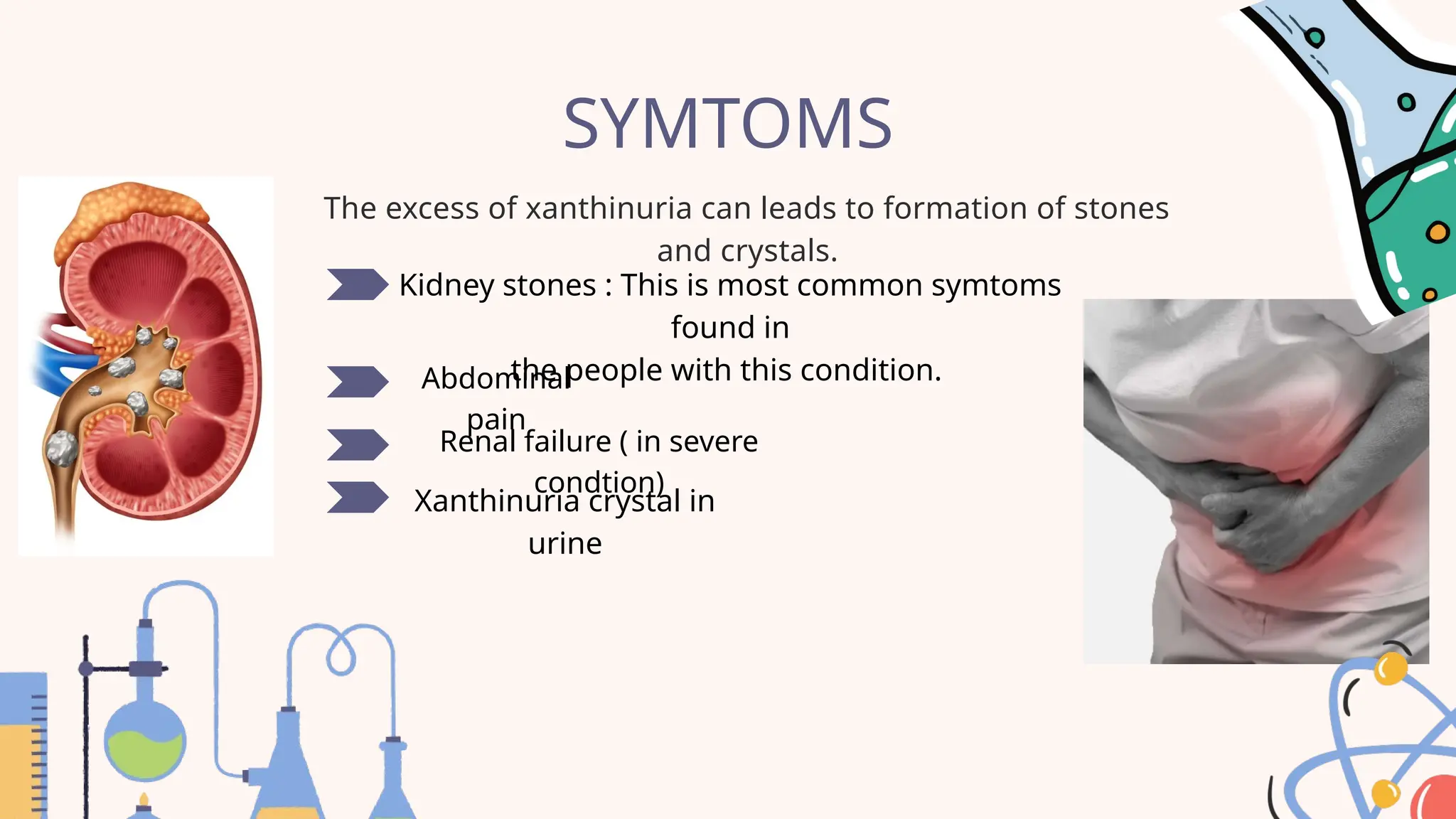 SYMTOMS
The excess of xanthinuria can leads to formation of stones
and crystals.
Kidney stones : This is most common symtoms
found in
the people with this condition.
Abdominal
pain
Renal failure ( in severe
condtion)
Xanthinuria crystal in
urine
 