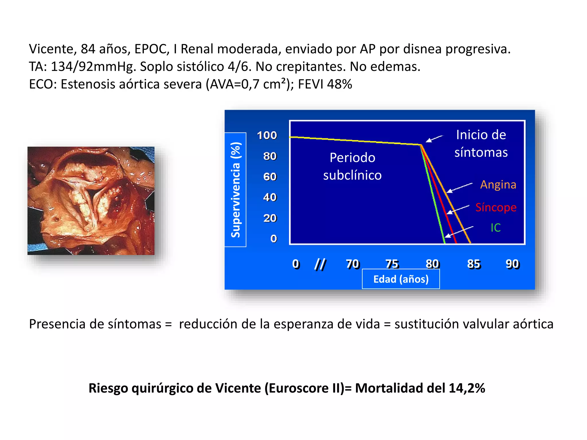 Vicente, 84 años, EPOC, I Renal moderada, enviado por AP por disnea progresiva.
TA: 134/92mmHg. Soplo sistólico 4/6. No crepitantes. No edemas.
ECO: Estenosis aórtica severa (AVA=0,7 cm²); FEVI 48%
0 70 75 80 85 90//
Edad (años)
Supervivencia(%)
Periodo
subclínico
Inicio de
síntomas
Angina
Síncope
IC
Presencia de síntomas = reducción de la esperanza de vida = sustitución valvular aórtica
Riesgo quirúrgico de Vicente (Euroscore II)= Mortalidad del 14,2%
 