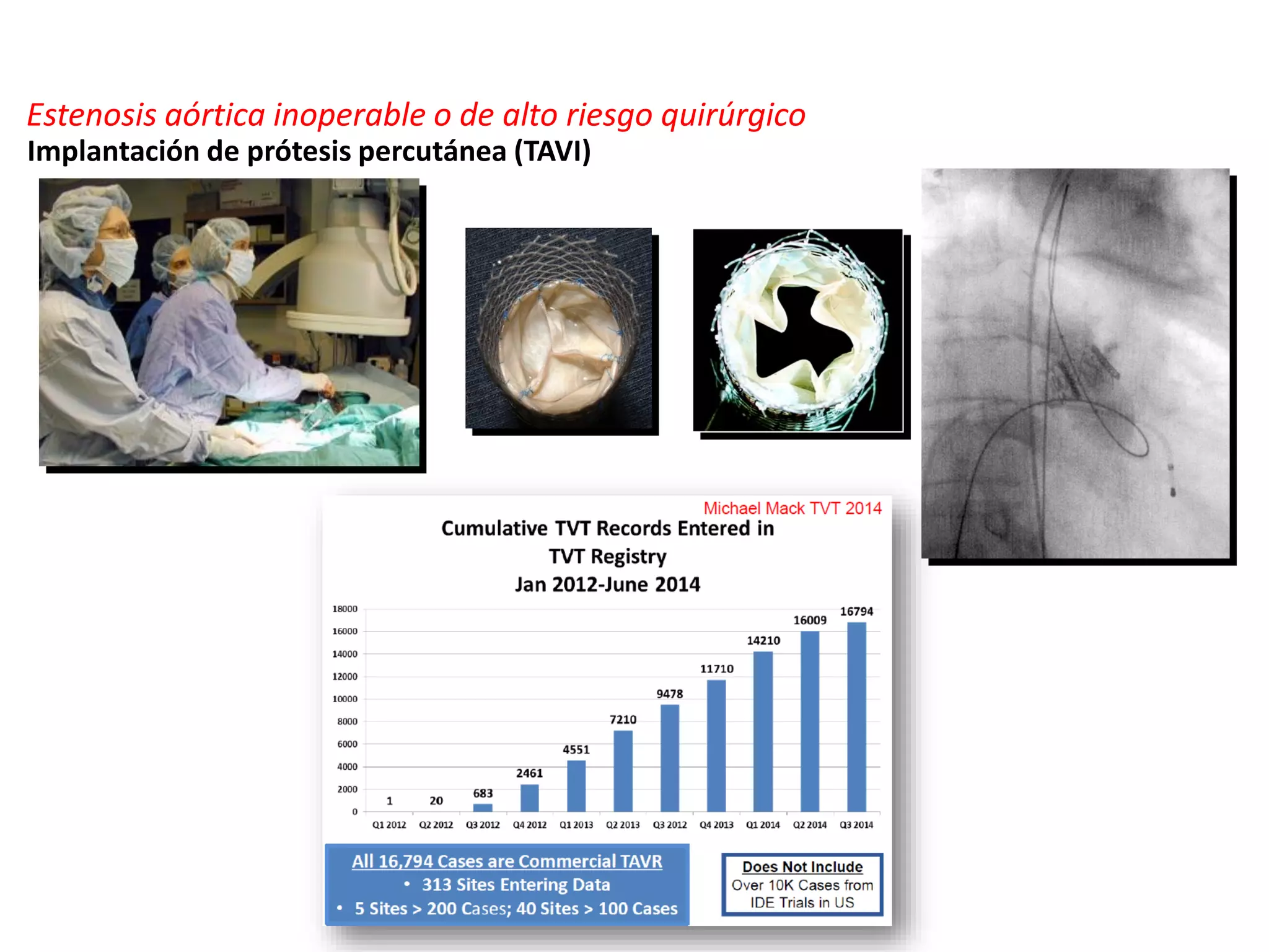 Estenosis aórtica inoperable o de alto riesgo quirúrgico
Implantación de prótesis percutánea (TAVI)
 