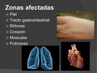 Zonas afectadas
 Piel
 Tracto gastrointestinal
 Riñones
 Corazón
 Músculos
 Pulmones
 