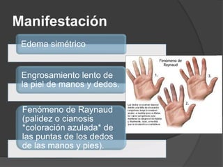Manifestación
Edema simétrico
Engrosamiento lento de
la piel de manos y dedos.
Fenómeno de Raynaud
(palidez o cianosis
*coloración azulada* de
las puntas de los dedos
de las manos y pies).
 