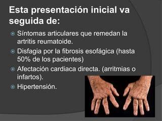Esta presentación inicial va
seguida de:
 Síntomas articulares que remedan la
artritis reumatoide.
 Disfagia por la fibrosis esofágica (hasta
50% de los pacientes)
 Afectación cardiaca directa. (arritmias o
infartos).
 Hipertensión.
 