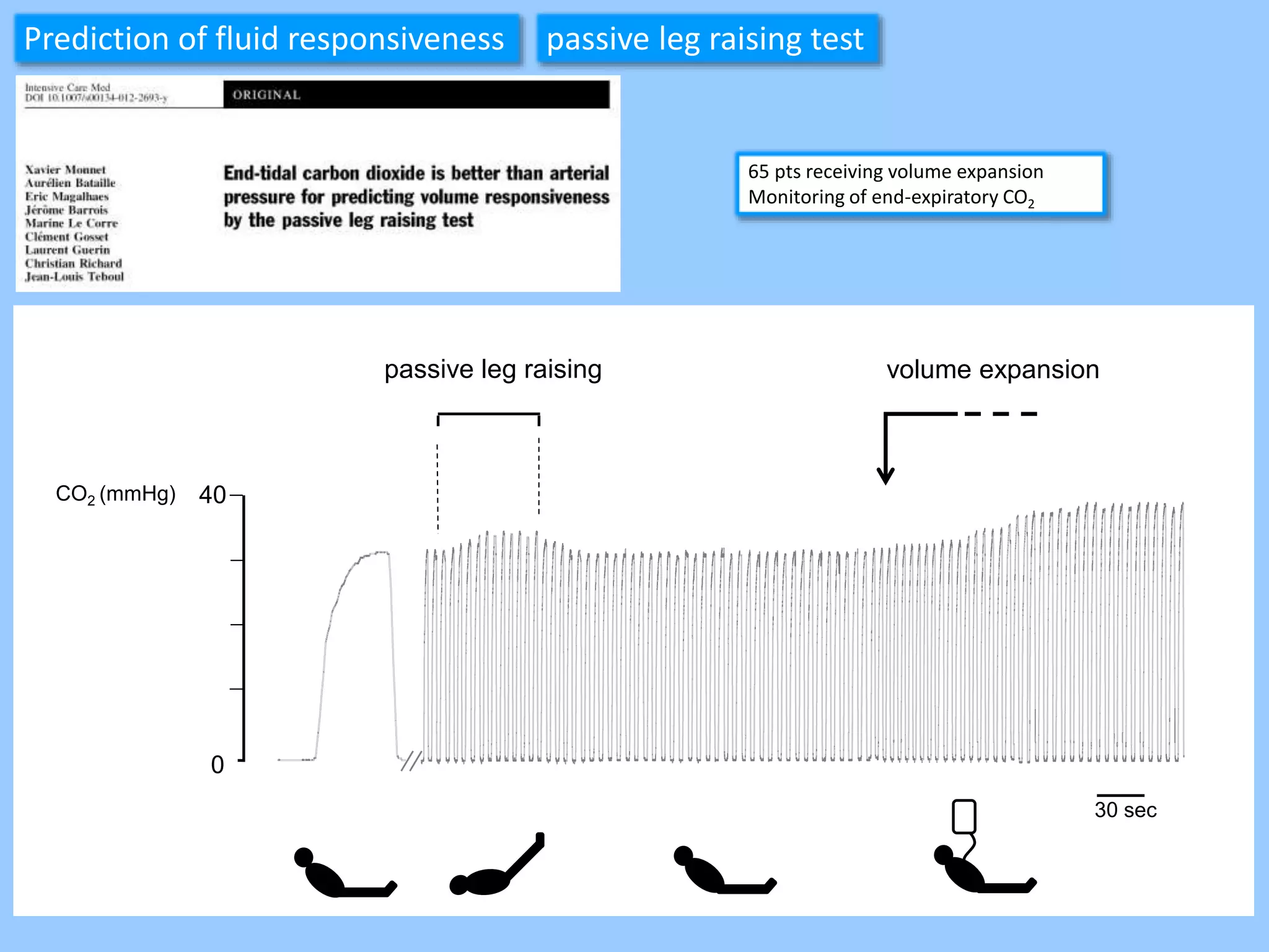 40CO2 (mmHg)
30 sec
0
Prediction of fluid responsiveness passive leg raising test
65 pts receiving volume expansion
Monitoring of end-expiratory CO2
passive leg raising volume expansion
 