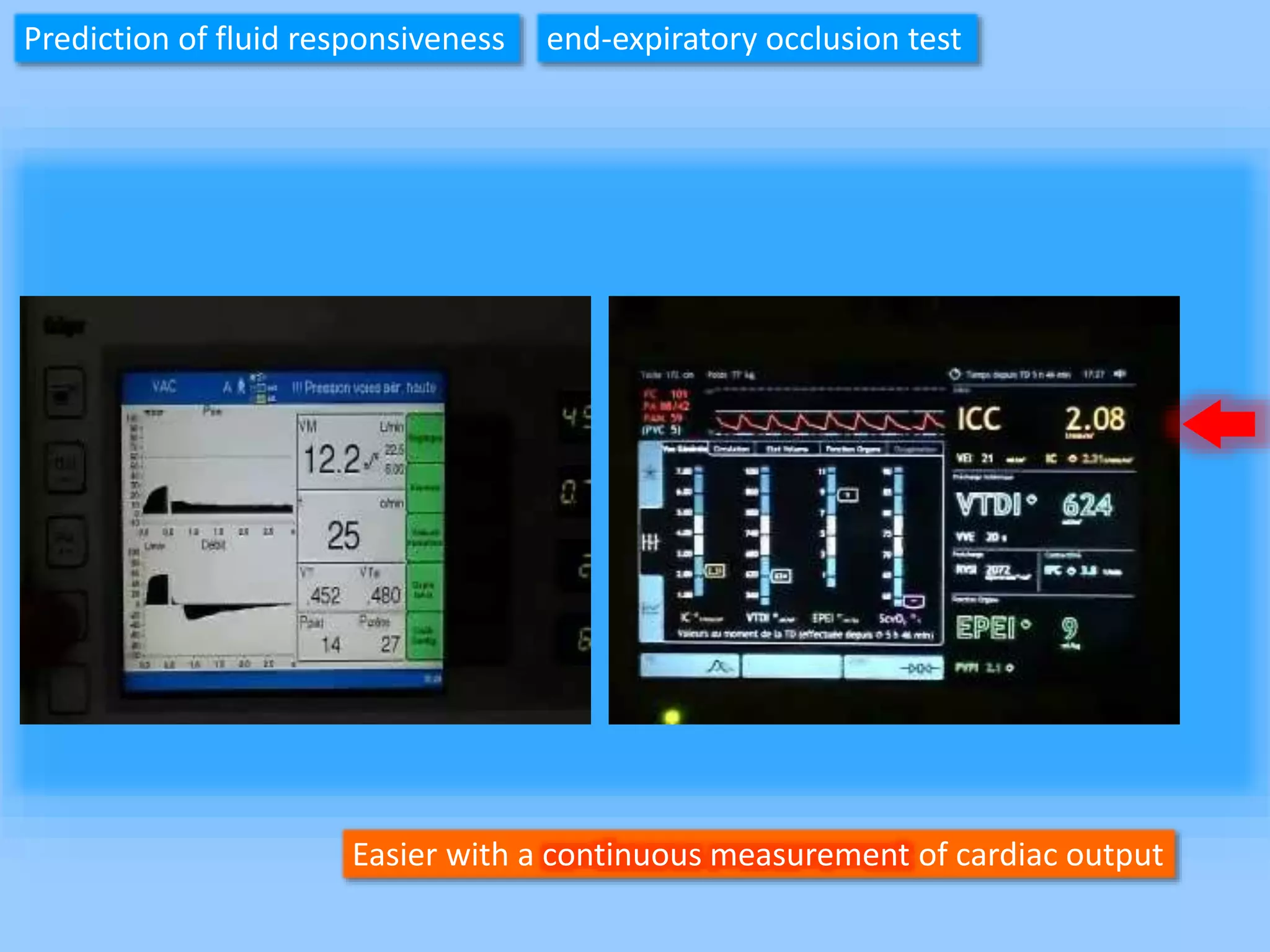 Easier with a continuous measurement of cardiac output
Prediction of fluid responsiveness end-expiratory occlusion test
 