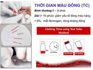THỜI GIAN MÁU ĐÔNG (TC)
Bình thường 6 – 9 phút.
Dài (> 15 phút): giảm yếu tố đông máu nặng
< 6%, mất fibrinogen, dùng kháng đông
 
