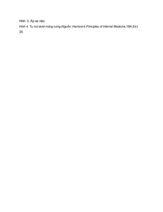 Hình 3. Áp xe não
Hình 4. Tụ mủ dưới màng cứng (Nguồn: Harrison’s Principles of Internal Medicine,16th Ed.)
35
 