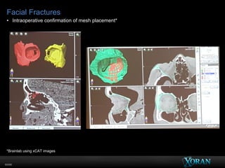 60096
Facial Fractures
• Intraoperative confirmation of mesh placement*
*Brainlab using xCAT images
 