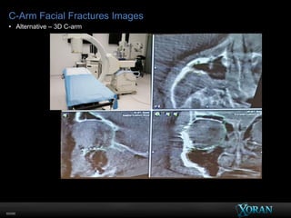 60096
C-Arm Facial Fractures Images
• Alternative – 3D C-arm
 