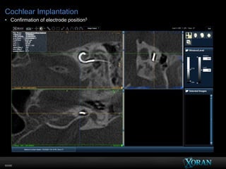 60096
Cochlear Implantation
• Confirmation of electrode position5
 