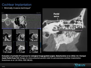 60096
Evaluation of portable CT scanners for otological image-guided surgery. Balachandran et al. 2012. Int J Comput
Assist Radiol Surg 7(2); Design of a bone-attached parallel robot for percutaneous cochlear implantation.
Kratchman et al. L.B. 2011. IEEE 58(10):
Cochlear Implantation
• Minimally invasive technique5
 