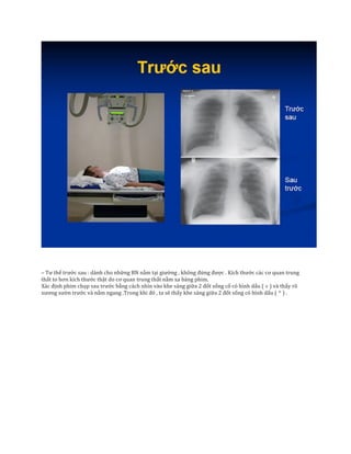 – Tư thế trước sau : dành cho những BN nằm tại giường , không đứng được . Kích thước các cơ quan trung
thất to hơn kích thước thật do cơ quan trung thất nằm xa bảng phim.
Xác định phim chụp sau trước bằng cách nhìn vào khe sáng giữa 2 đốt sống cổ có hình dấu ( ˅ ) và thấy rõ
xương sườn trước và nằm ngang .Trong khi đó , ta sẽ thấy khe sáng giữa 2 đốt sống có hình dấu ( ^ ) .
 