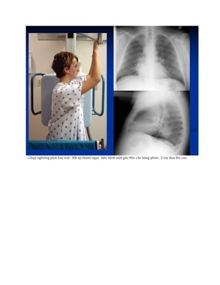 – Chụp nghiêng phải hay trái : BN áp thành ngực bên bệnh một góc 90o vào bảng phim , 2 tay đưa lên cao .
 